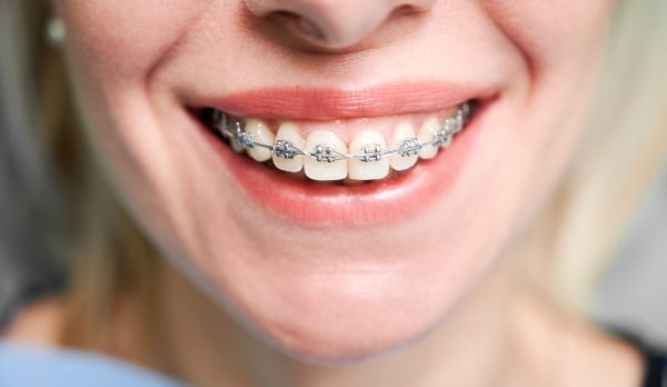 Close up of woman with charming smile demonstrating white teeth with orthodontic brackets. Female patient showing results of dental braces treatment. Concept of orthodontic treatment and dentistry.